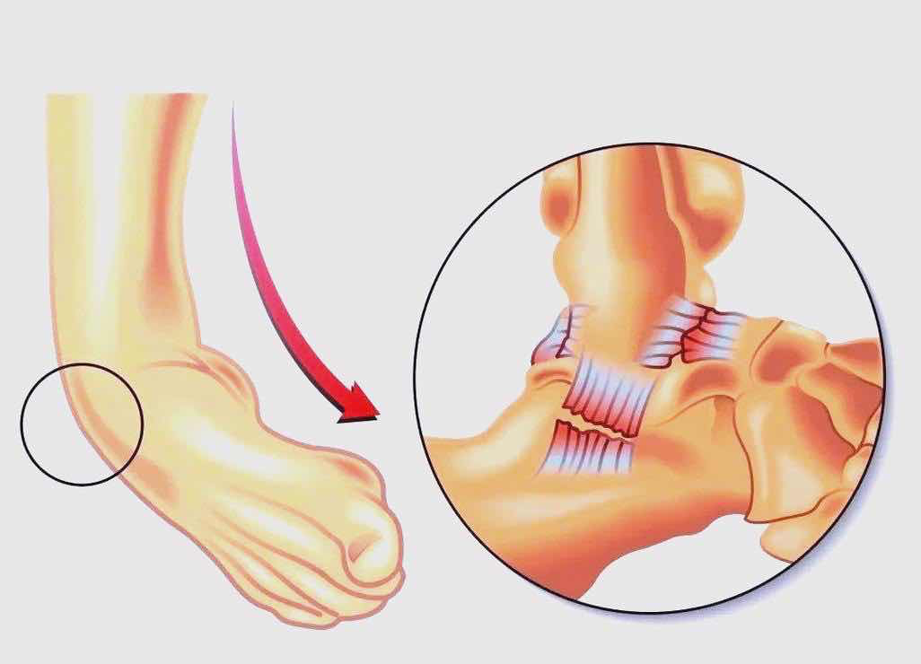 【中心科普】崴脚不是小事！踝关节的秘密与正确急救法